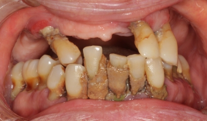 Close up of smile with missing and damaged teeth